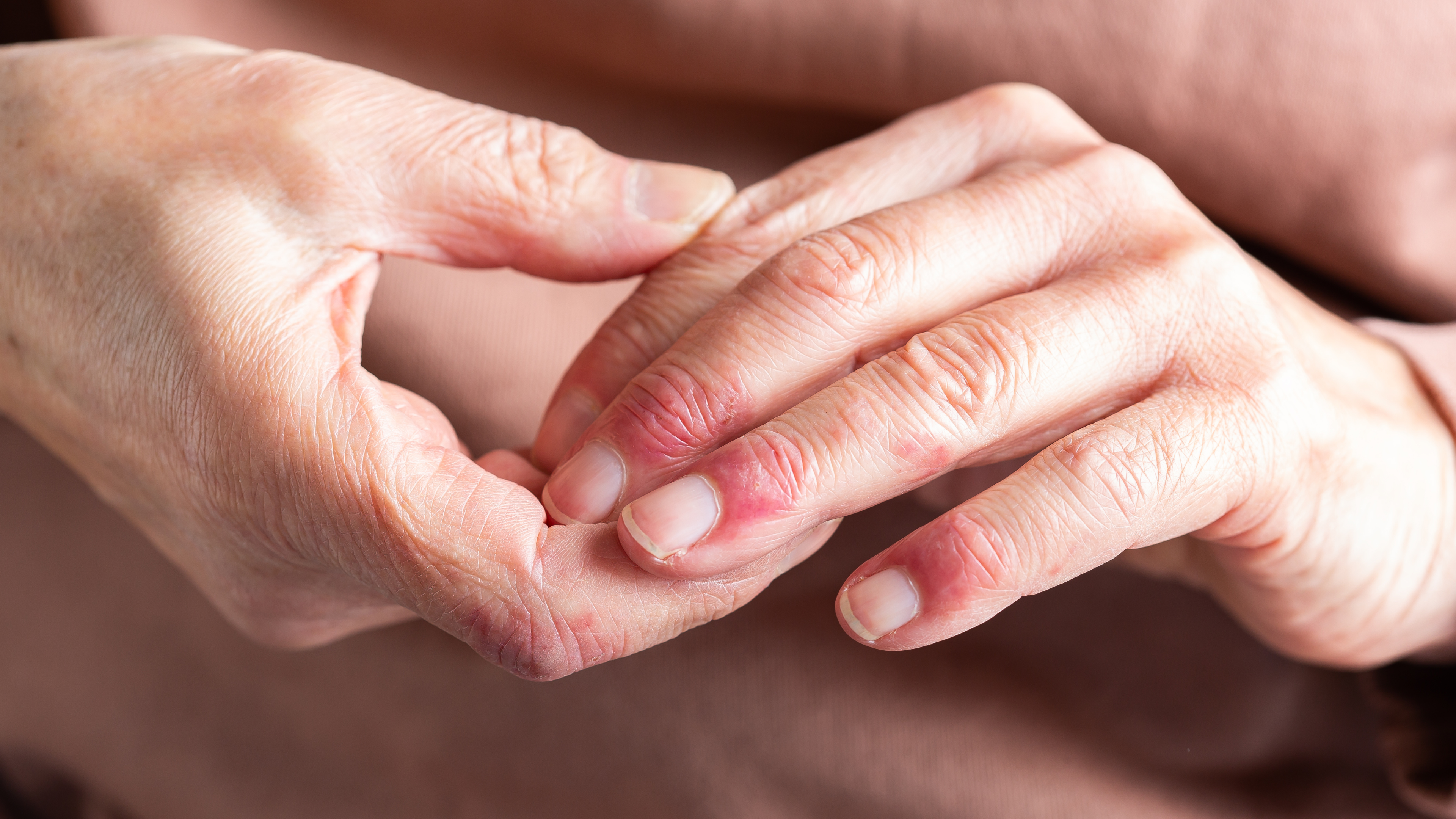 Close-up of a woman’s hands showing stiffness and soreness from arthritis, gently resting on her lap, highlighting chronic hand pain.