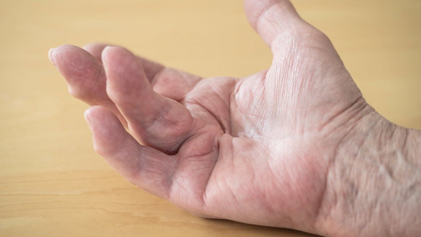 A hand affected by Dupuytren's Contracture, with fingers bent toward the palm due to tight cords of tissue.