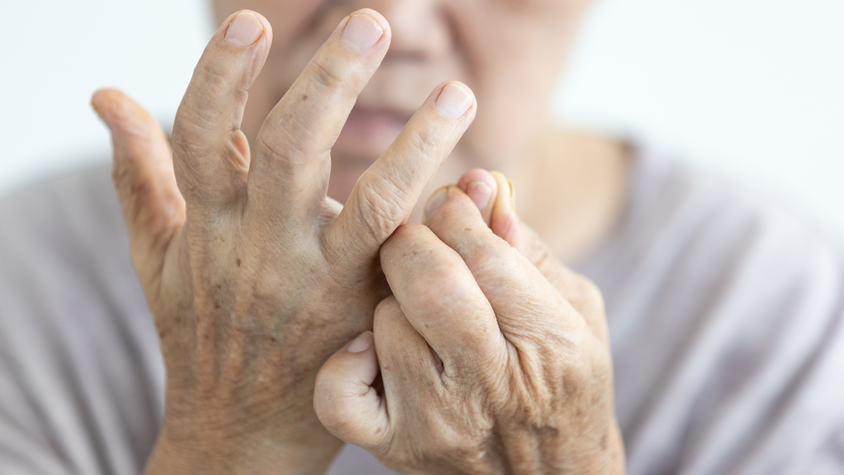 Elderly woman with arthritis showing her arthritic hand.